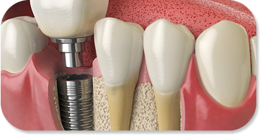 Guided Implant Placement No Guesswork