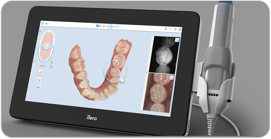 iTero Digital Scanner