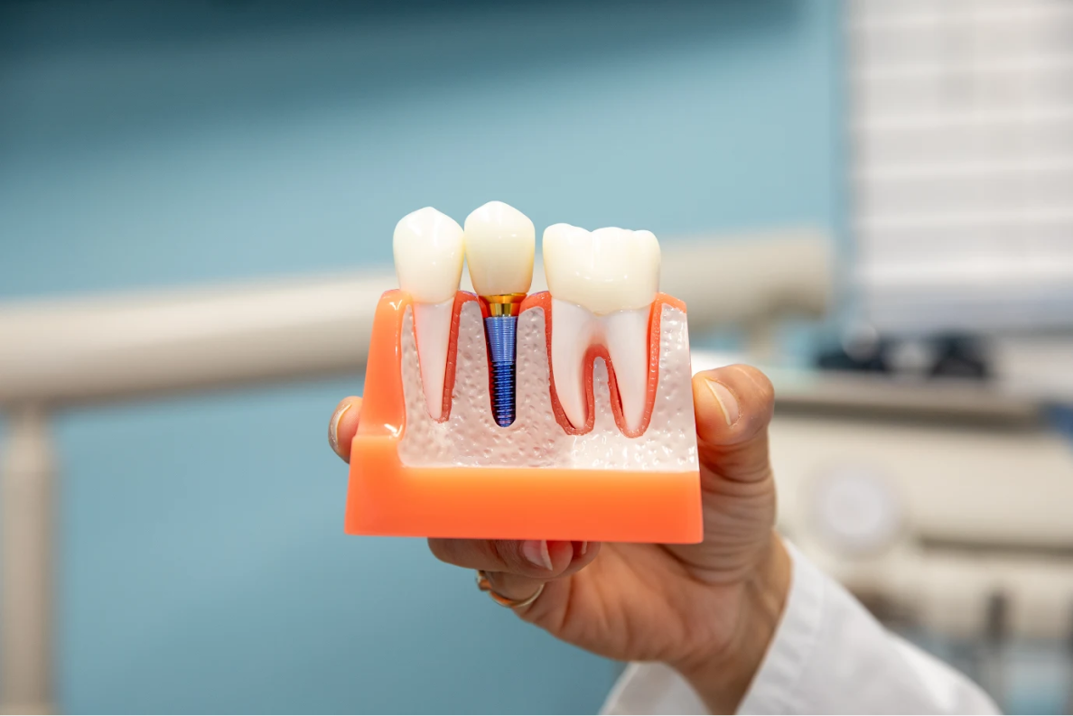 Dental Implants