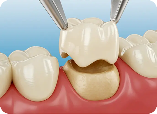 Are Dental Crowns Right For You