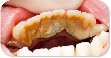 Fillings That Actually Match Your Teeth