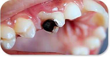 AI-Powered Cavity Detection