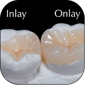Ceramic / Porcelain Inlays & Onlays
