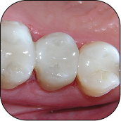 Composite Resin Fillings (Tooth-Coloured)
