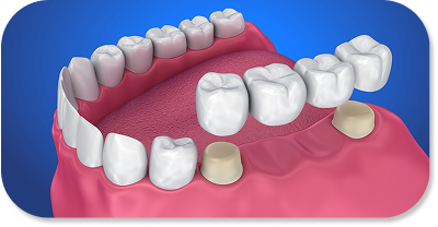 DENTAL BRIDGE