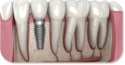 DENTAL IMPLANTS