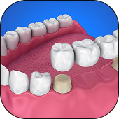 Dental Bridges