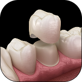 Dental Crowns
