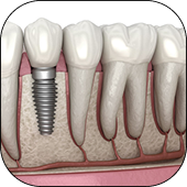 Dental Implants