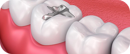 Fillings That Actually Match Your Teeth