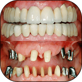 Full mouth restoration
