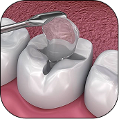 Glass Ionomer Fillings