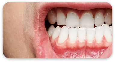 Healthy Gums