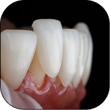 PORECELAIN VENEER