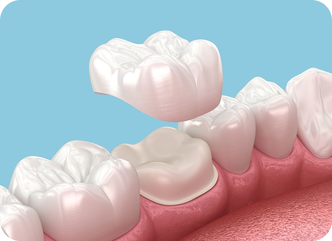 Same Day Crowns