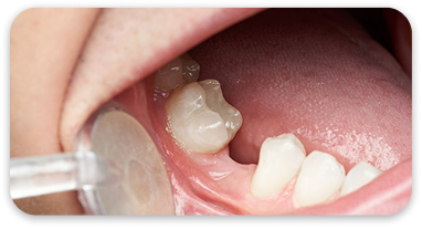Sufficient jawbone density