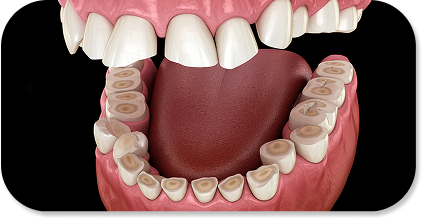 Teeth grinding (bruxism)