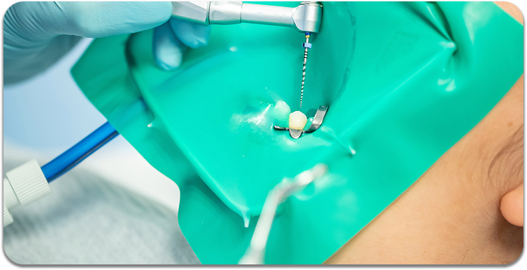 Root Canal Treatment