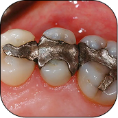What About Amalgam (Silver) Fillings?