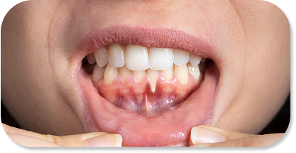 Early gingivitis or gum disease